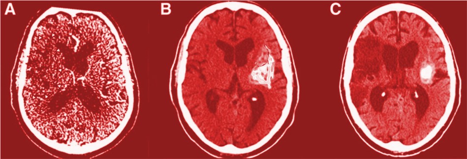 Prześwietlenie uszkodzonego mózgu